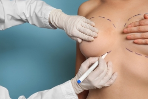 Réduction mammaire à Genève