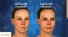 Tout savoir sur le mid-face lift : technique, bénéfices et résultats